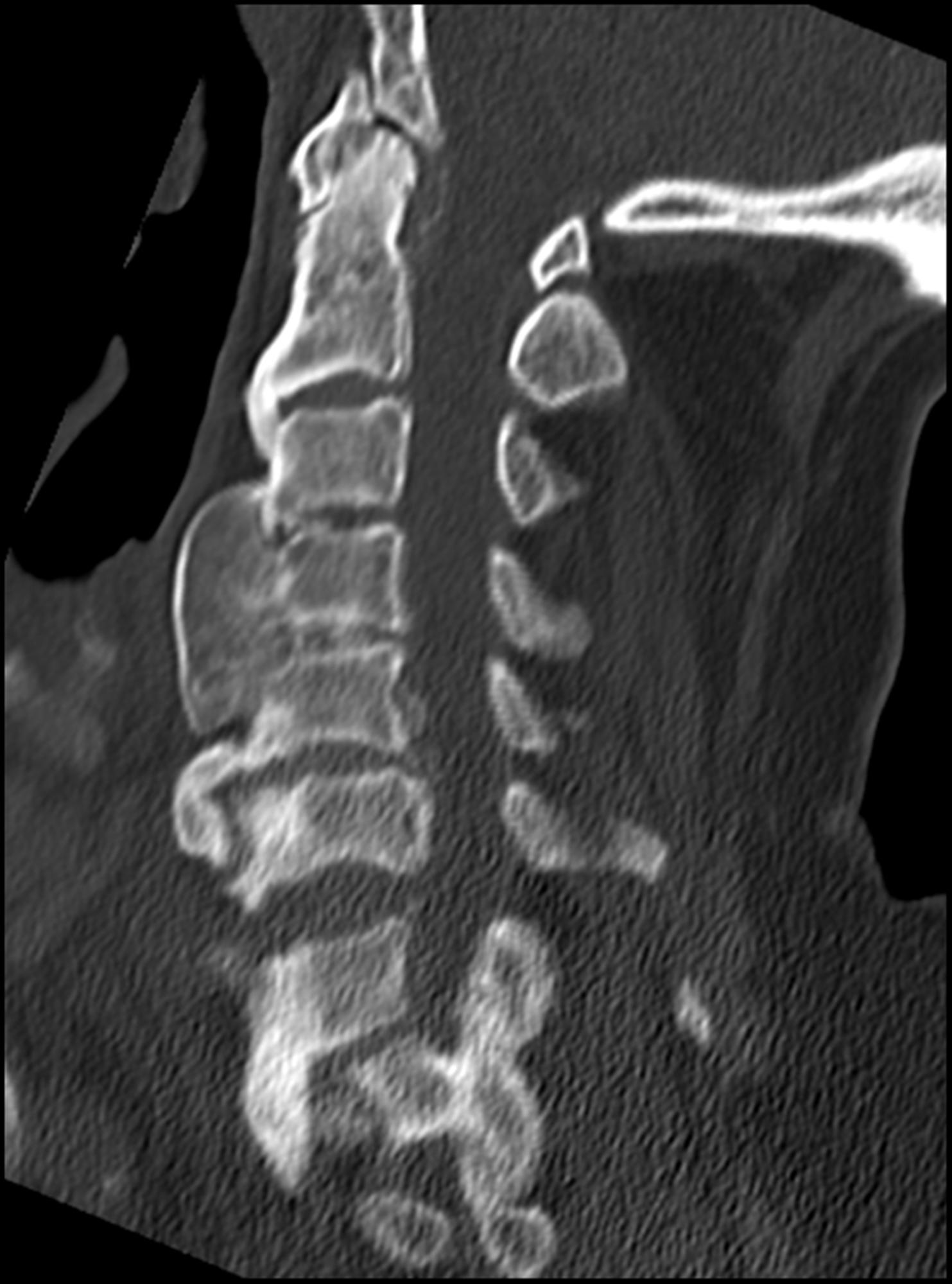 DISH (Diffuse Idiopathic Skeletal Hyperostosis) Spine Orthobullets